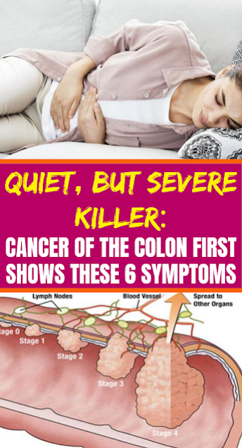 Quiet, But Severe Killer: Cancer Of The Colon First Shows These 6 Symptoms