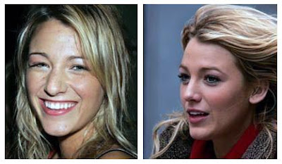 Blake Lively Plastic Surgery