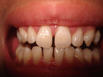 Nguyên nhân răng thưa và cách khắc phục