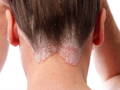 Cách điều trị nấm da đầu
