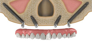 Cấy ghép implant trong nha khoa là gì-3