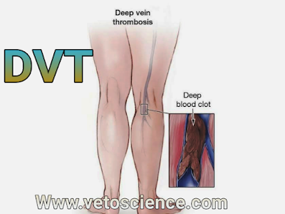 what is Deep vein thrombosis (DVT) in Hindi