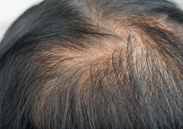when is it too late to stop hair loss?