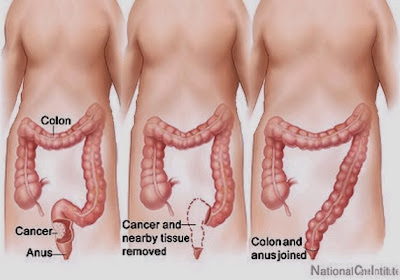 Colon polyps: symptoms you should know