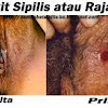 Jurnal Penyakit Sifilis