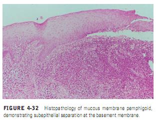 MUCOUS MEMBRANE PEMPHIGOID (CICATRICIAL PEMPHIGOID)