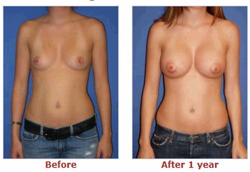 breast augmentation before and after c. reast augmentation before and