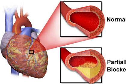 Definisi, Gejala, Dan Pengobatan Penyakit Jantung Koroner