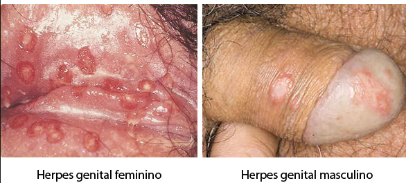 cara mengobati herpes menahun