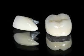 bọc răng sứ titan kim loại