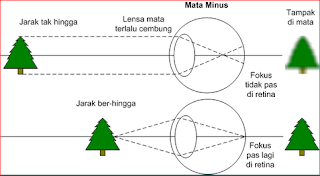 Cara Menyembuhkan Mata Minus