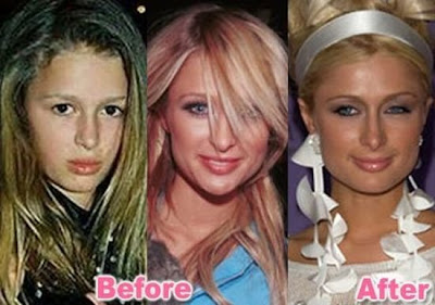 celebrity plastic surgery