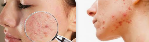Fighting Hormonal Acne: Expert Tips for Treatment and Prevention