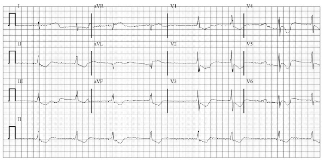 Digoxin toxicity ECG