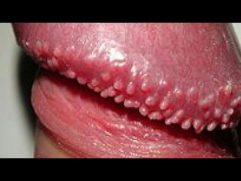 Human Papillomavirus Hpv Videos