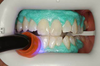 Gingival Barrier | ZOOM Teeth Whitening