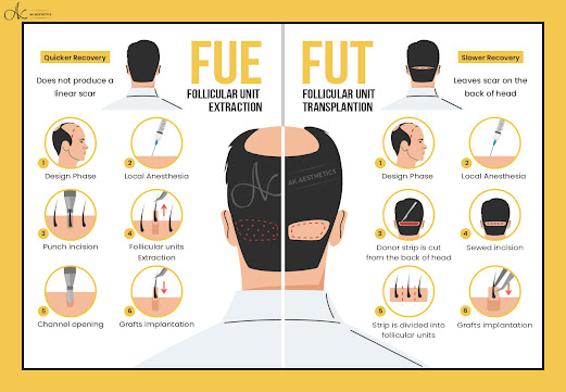 FUT v/s FUE Hair Transplant