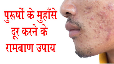 home remedies for men's acne