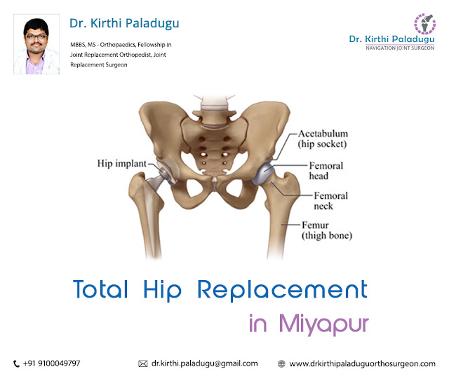  Total Hip Replacement in Miyapur
