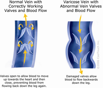 Vein Valve, Gambar katup vena normal dan perbandingannya dengan yang mengalami kerusakan, arus alirah darah, pembuluh, varises