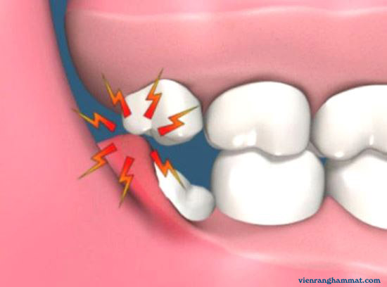 Nhận biết viêm nhiễm sau khi nhổ răng khôn