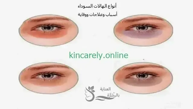 أنواع الهالات السوداء