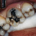 Khắc phục mẻ răng bằng phương pháp nào?