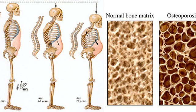 what is osteoporosis arthritis