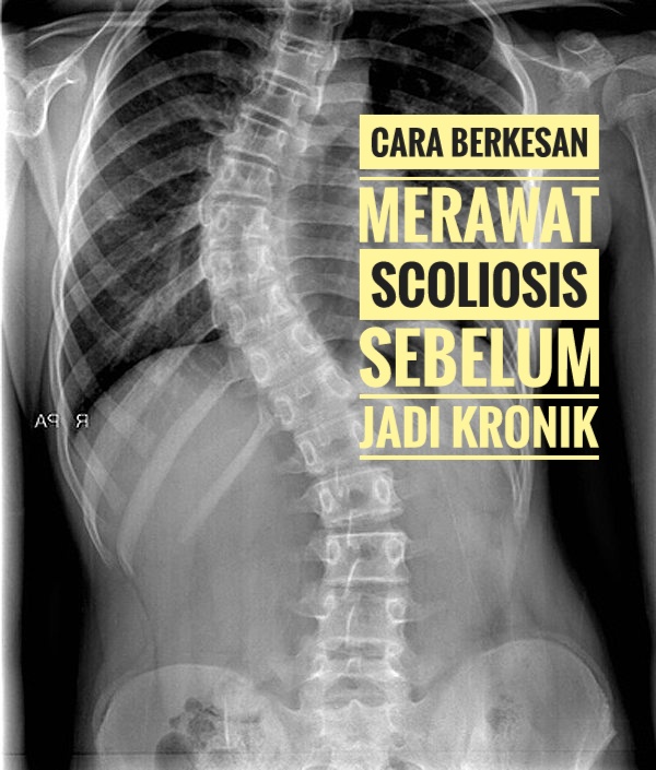 Cara Berkesan Merawat Scoliosis Sebelum Jadi Kronik 