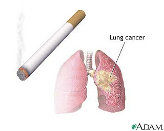 lung cancer