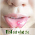  7 Best Tips to treat White Spots on Lips