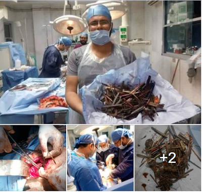 Psychic Disorder: Doctors Remove Nails, Spoon, Wood and Other Materials from a Woman’s Stomach