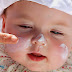 Kenali Jenis-Jenis Alergi Pada Anak