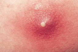 All About Boils, Causes and How To Treat It