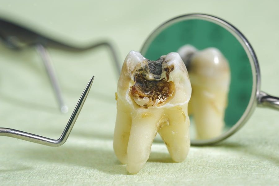 Diş Çürükleri kalp-damar hastalıklarına neden olabilir!