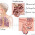 Mesothelioma cancer is malignant  (article)