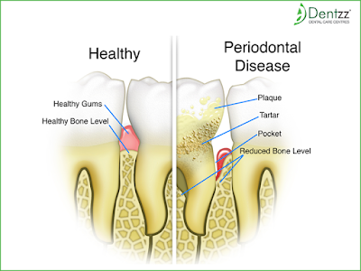 Dental Care- Dentzz Dental