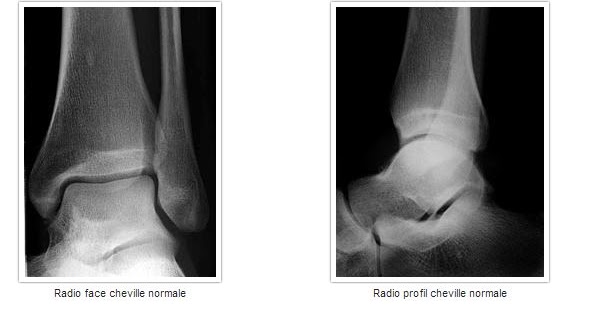 Un médecin du sport vous informe: fractures des malléoles de la ...