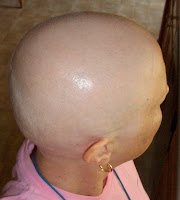 Bald head after