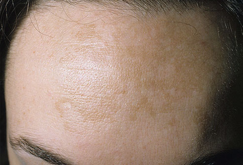 ANTI-AGING and SKIN CORRECTION BLOG: Melasma and Skin Damages