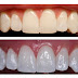 Best teeth whitening methods 2012 - Whiten Your Smile Naturally  Beauty Blog by Ms Toi