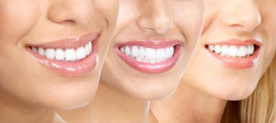Tẩy trắng răng như thế nào để hiệu quả nhất?