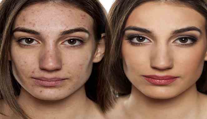 Lima Langkah Cepat Menyembunyikan Jerawat dengan Makeup