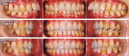 歯列矯正：定期検診その29
