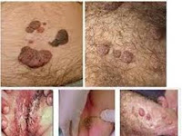 Obat Kutil Pd Kelamin