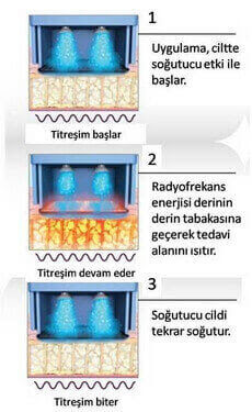 thermage uygulama aşamaları