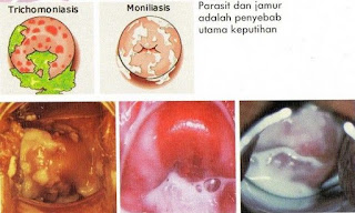 Obat Keputihan Resep Dokter