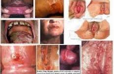 http://obatsipilis-tradisional.blogspot.com/2015/09/obat-sifilis-terbaik-di-indonesia.html