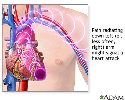 heart attack diagram. Heart attack symptoms