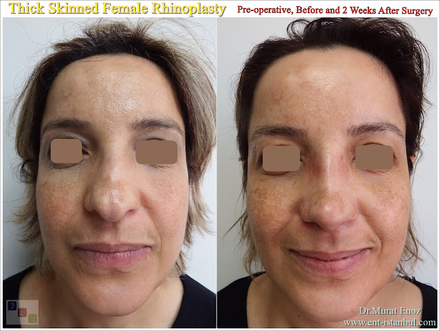 Thick and asymmetrical nose job, Female rhinoplasty, Asymmetric female nose aesthetics, Oily nose, Crooked nose, Scoliotic nose